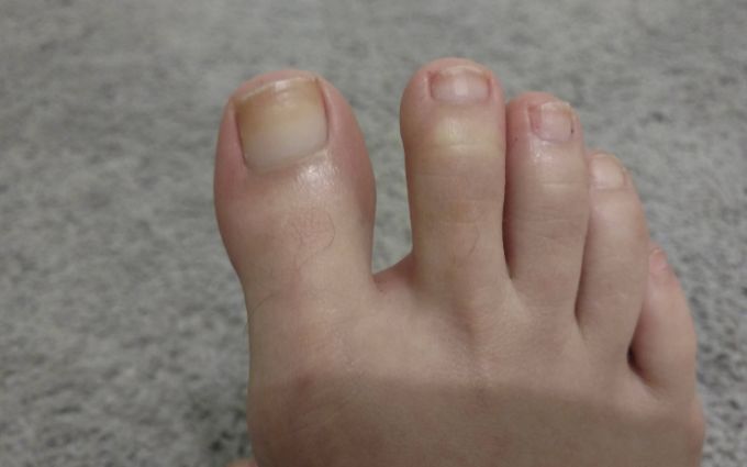 The NailScience 2-Step Nail Restoration Kit