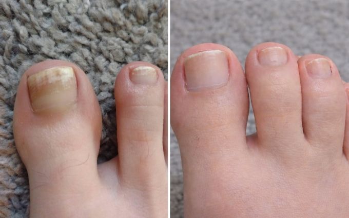 The NailScience 2-Step Nail Restoration Kit